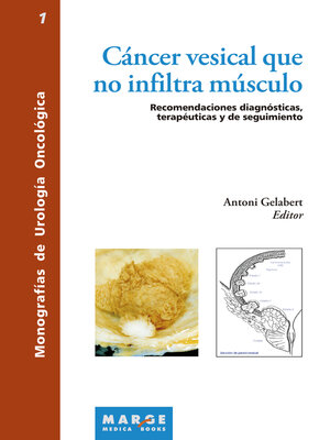 cover image of Cáncer vesical que no infiltra músculo